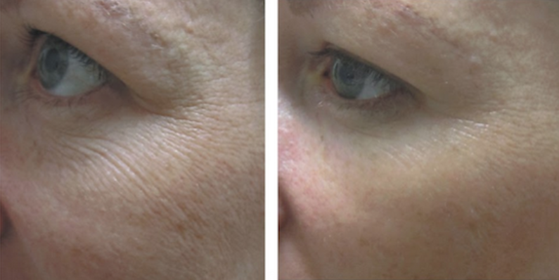 A woman 's eye and face before and after treatment.