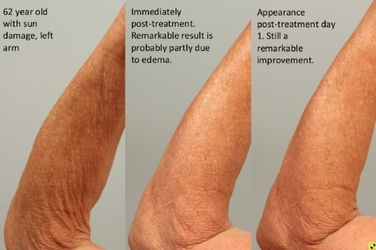 Three pictures of a person 's hand with different treatments.